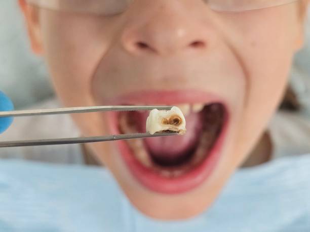 Best Emergency Tooth Extraction in Amerin Nyon, CA